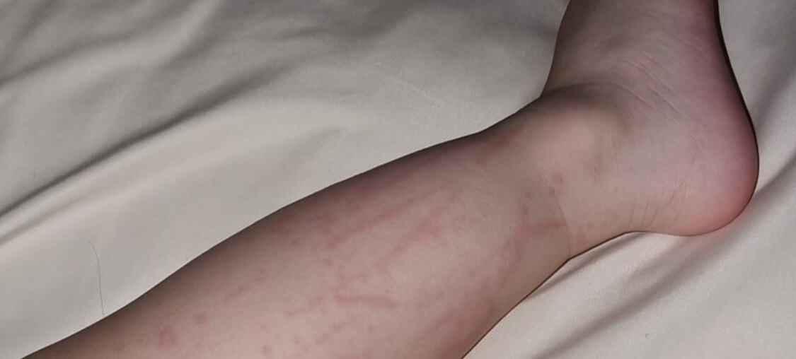 수족구 증상 예방 조치 전염 기간