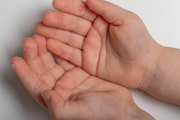 수족구 증상과 원인&#44; 치료