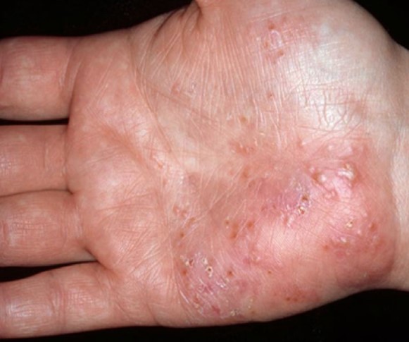 심하게-물집이-잡힌-손바닥