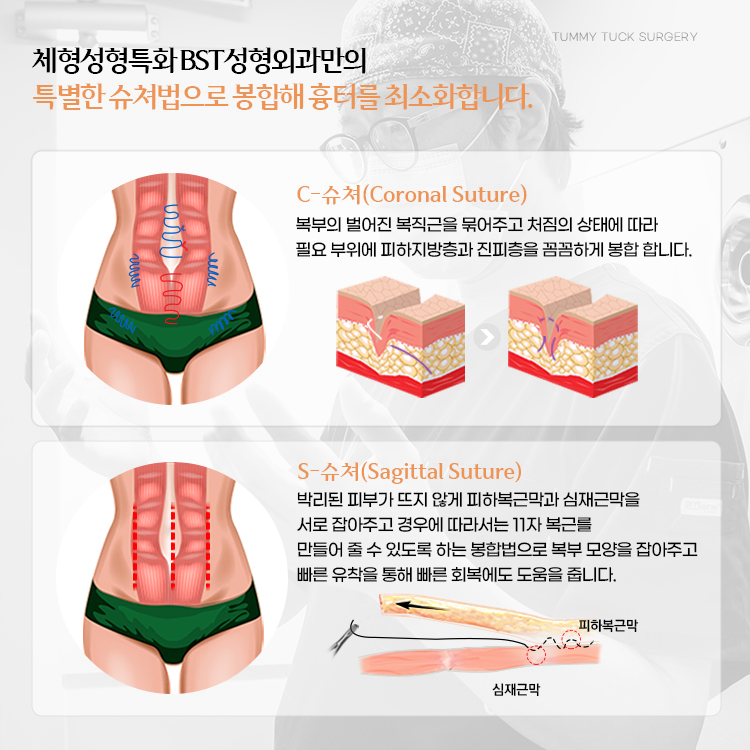 체형성형특화 BST성형외과만의 특별한 슈쳐법으로 봉합해 흉터를 최소화합니다.