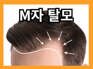 머리카락이 많이 빠지는 이유 - M자 탈모