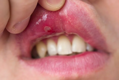 구내염 증상