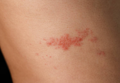 대상포진 초기증상