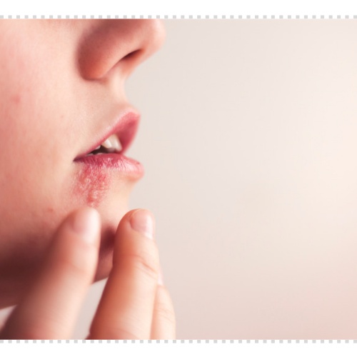 귀 대상포진 증상 후유증