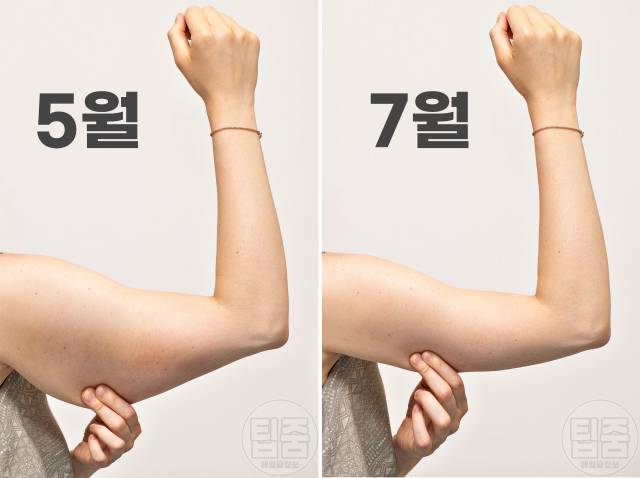 팔뚝 얇아지는 운동 팔뚝살빼기 2개월 비포애프터