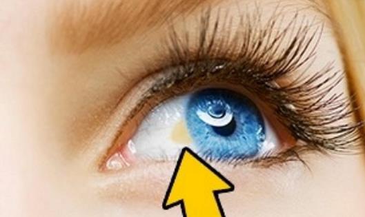 치매 신호 망막 노란색 반점