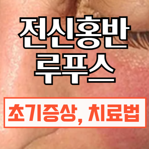 전신홍반루푸스(SLE)초기증상,원인,치료법