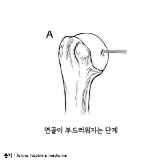 어깨통증원인
