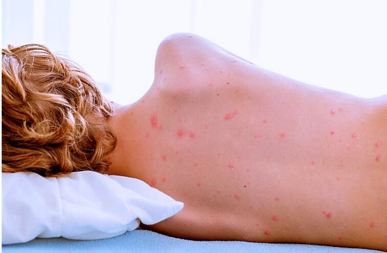 홍역예방접종 성인 홍역 예방접종