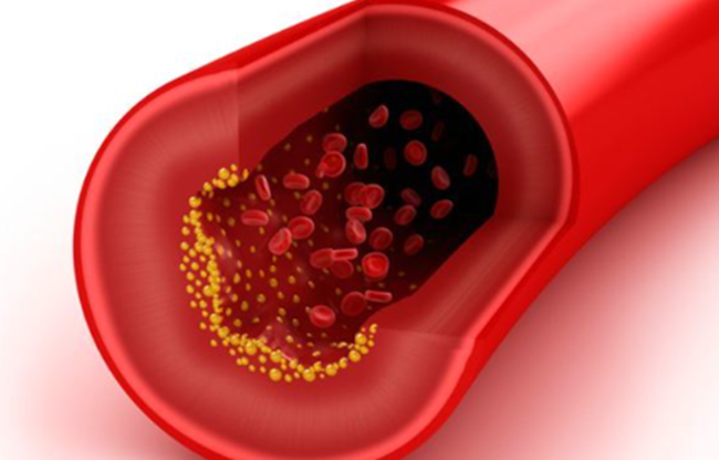 콜레스테롤 낮추는 방법
