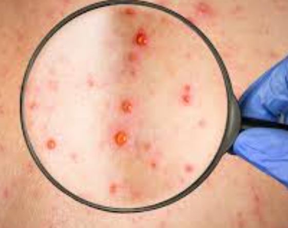 대상포진 간지러움