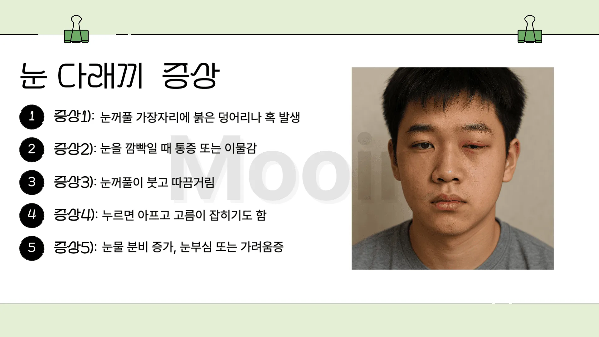 눈 다래끼 증상