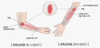 팔꿈치 통증 원인 6가지증상운동법예방법치료법까지_7