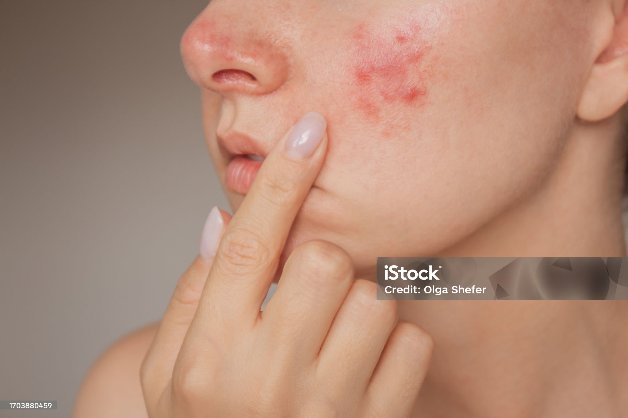 여성이 여드름을 손으로 가리키고 있다.