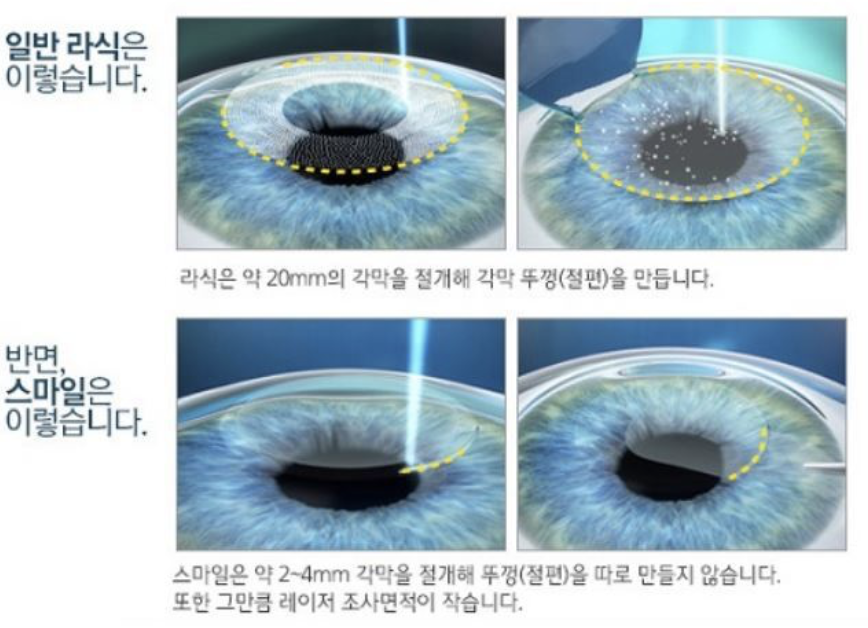 스마일라식-비용-부작용