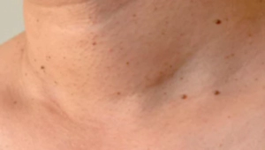 쥐젖이 생기는 이유, 쥐젖 제거방법