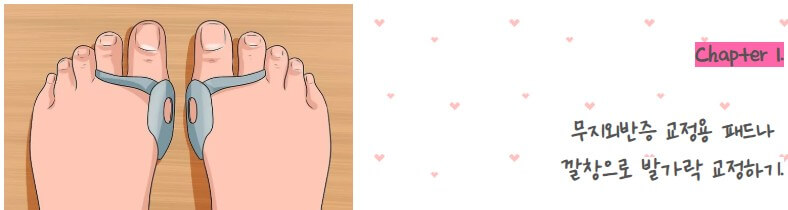 무지외반증 발가락 교정