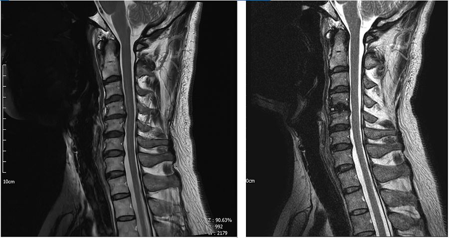 경추 MRI 세로 사진. T2사진이며 수술전(좌) 수술후(우)