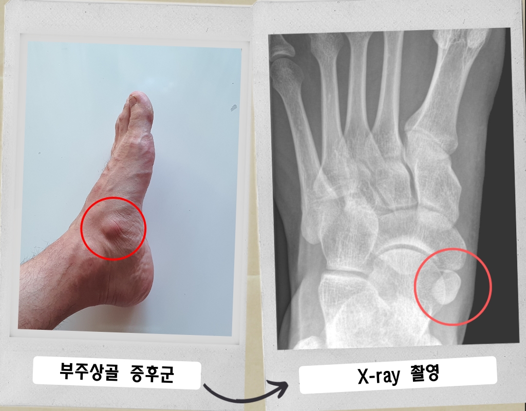 부주상골증후군_엑스레이_촬영