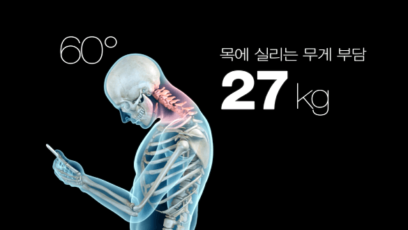 거북목 발생3
