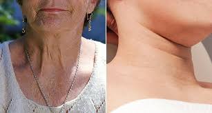 목주름 없애는 비결