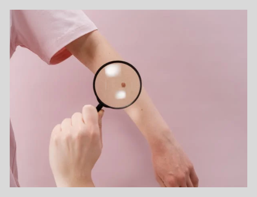 점뺀후 재생테이프 붙이는 기간