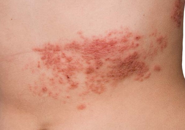 대상포진 초기증상 대상포진 조기치료 대상포진 초기증상 및 조기치료