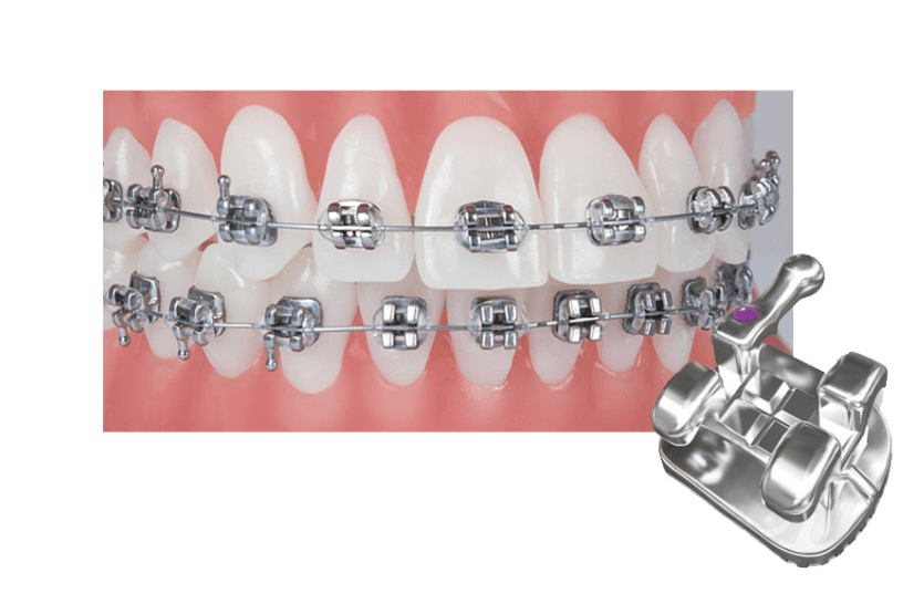 메탈 브라켓: 가장 오래된 방식의 검증된 효과