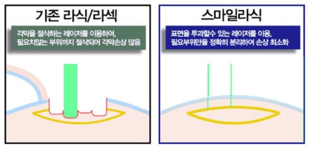 라식수술 비용