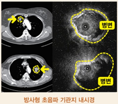 호흡기 질환: 폐결절- 종류, 원인, 증상, 진단, 치료방법.