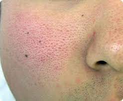 모공확장증 모습