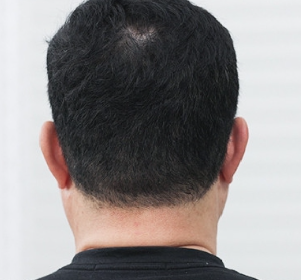 인포벨 장미화 동안 렛미모 내돈내산 후기