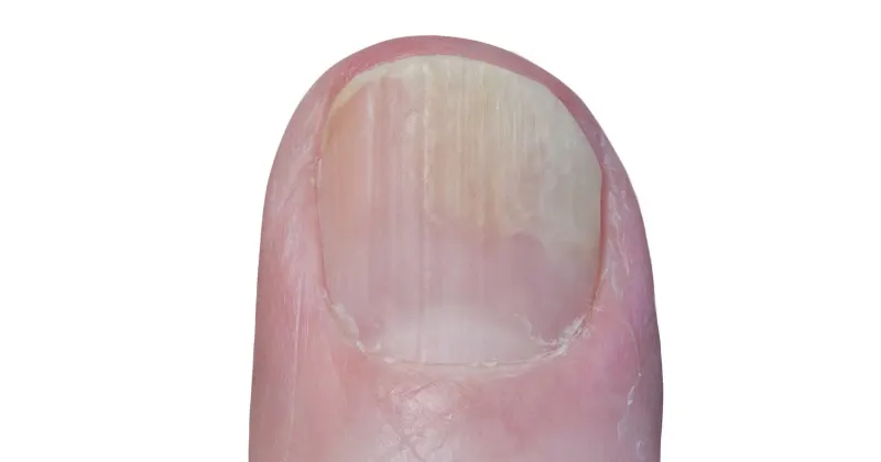 건선