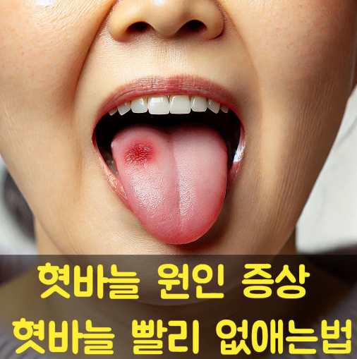 혓바늘 원인 혓바늘 없애는법 혓바닥 갈라짐