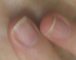 손톱 색깔로 보는 건강