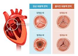 대동맥판막 역류증