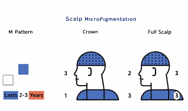 두피문신하는 전과정