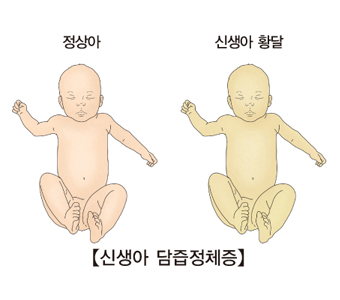 황달
