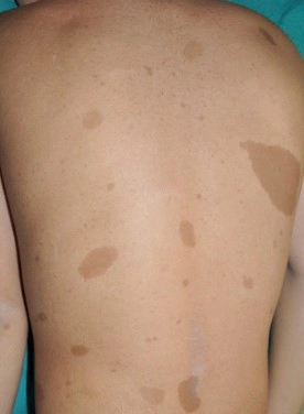 신경섬유종 밀크반점이란?