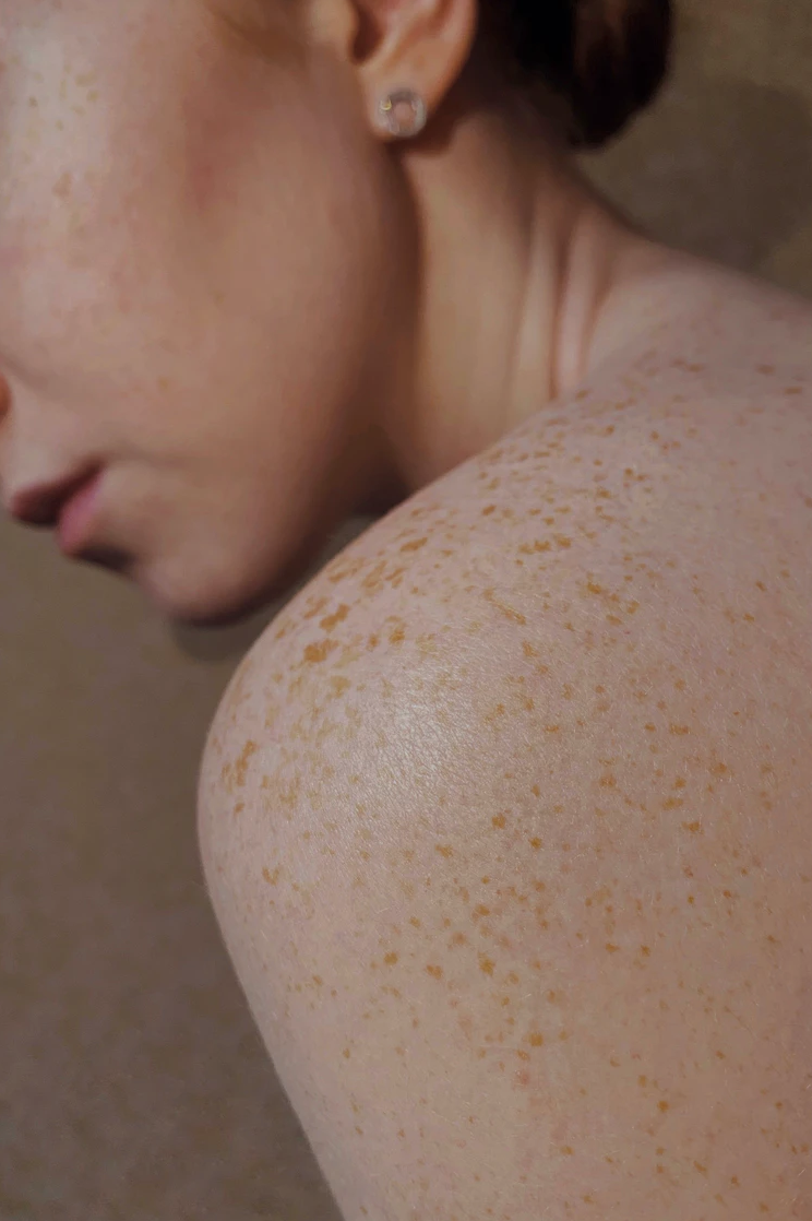 대상포진 초기증상 원인과 해결법