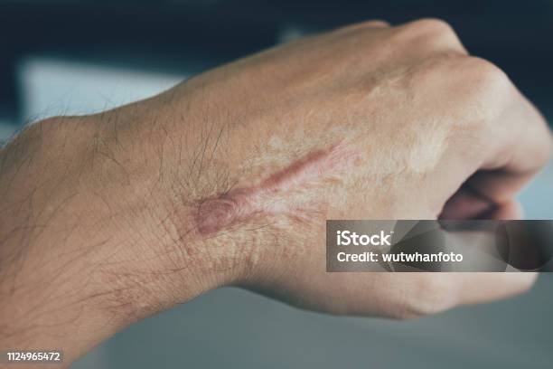 켈로이드 관련 사진