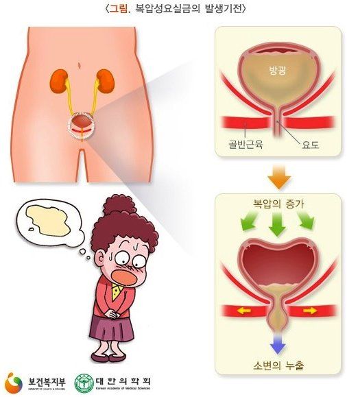 요실금 치료방법