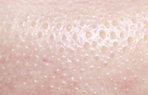 좁쌀 여드름 없애기