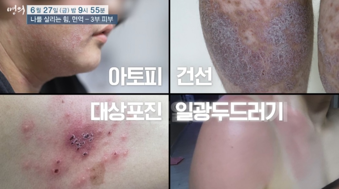 피부-명의-최용범-교수-일광두드러기