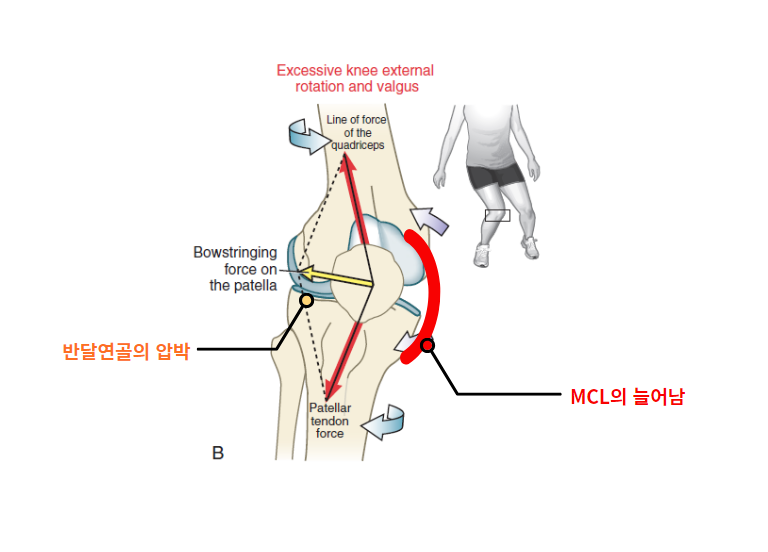 ACL 손상 기전