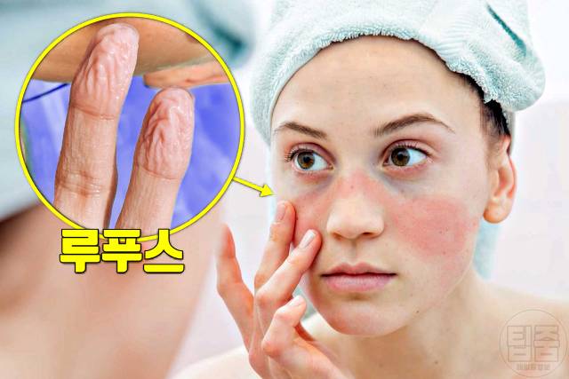 손가락 주름 병 질환 루푸스