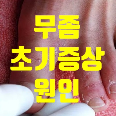 무좀 초기증상 원인