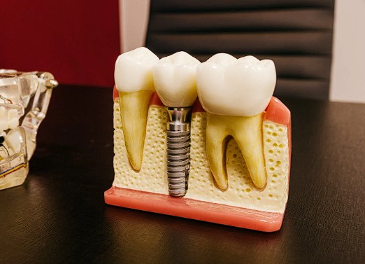 임플란트-보험적용