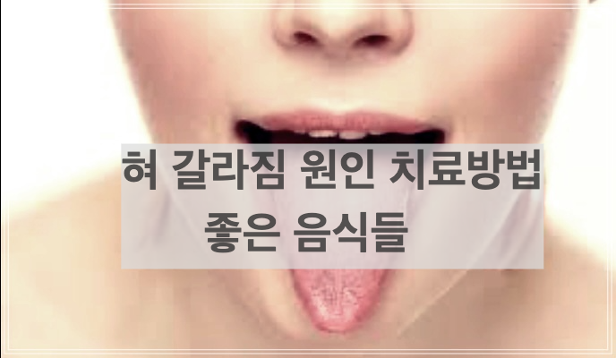 혀 갈라짐 원인 치료방법과 좋은 음식들