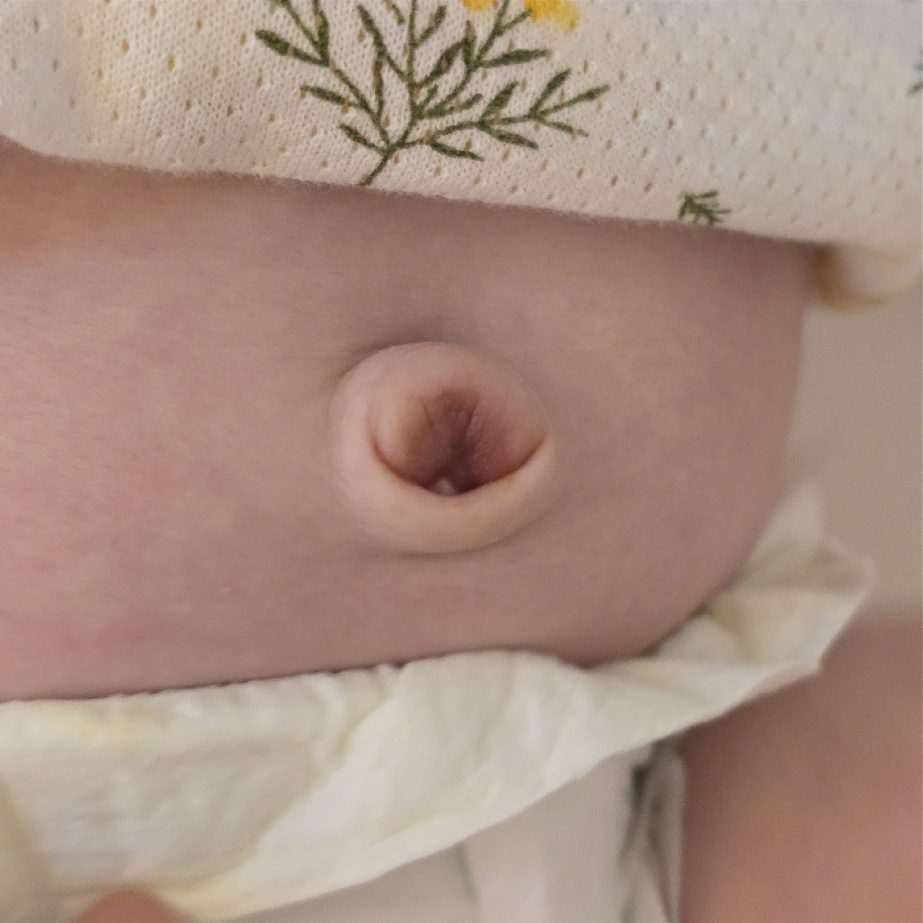 신생아 배꼽 탯줄 떨어진 자리 진물, 빨간 살